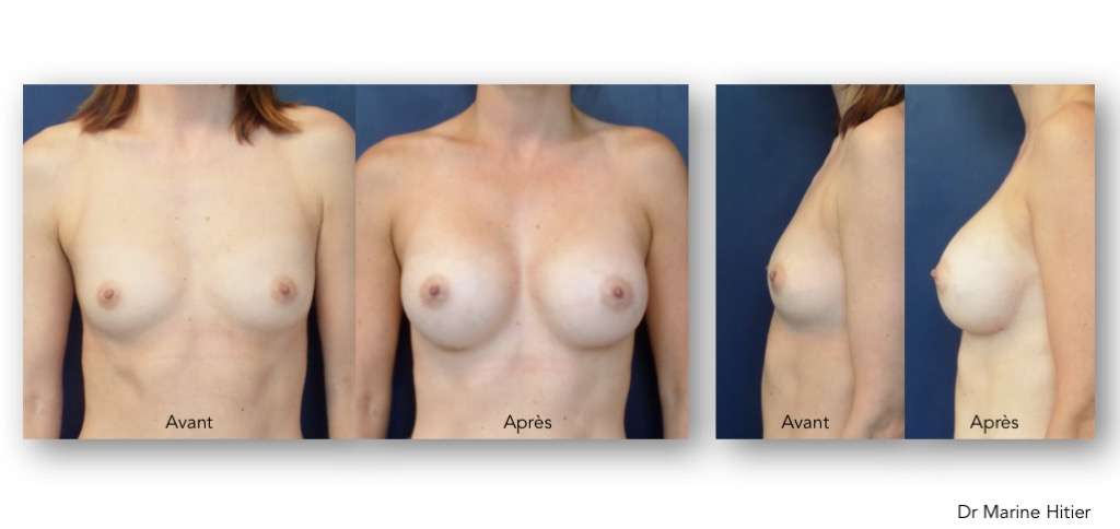 Implants mammaires
