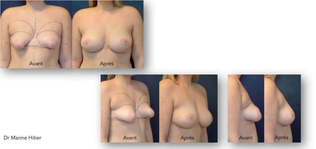 lipofilling seins tubéreux