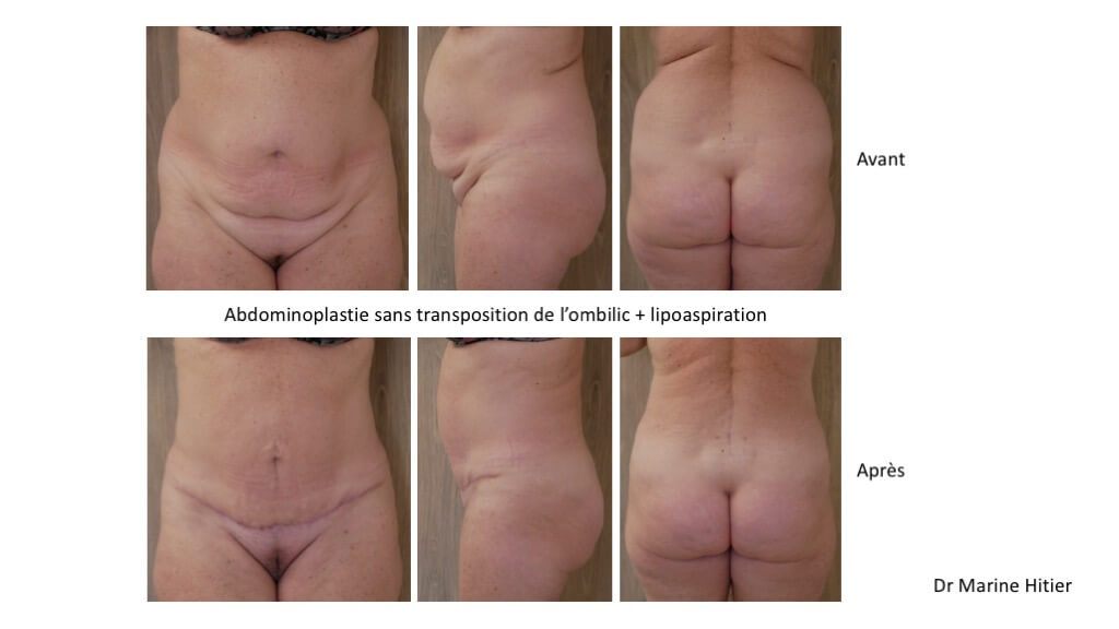 abdominoplastie lipoaspiration