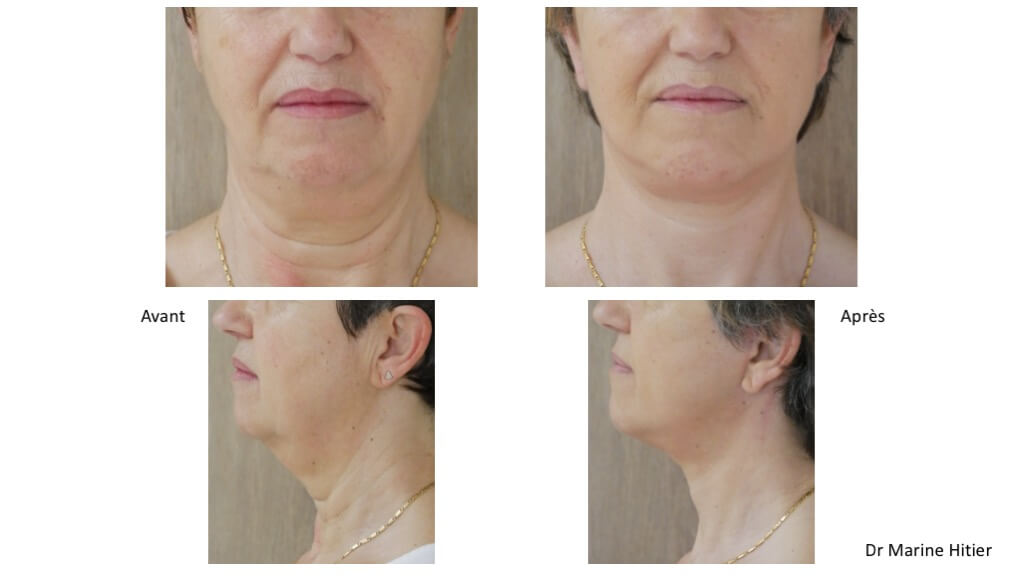 lifting cervico-facial