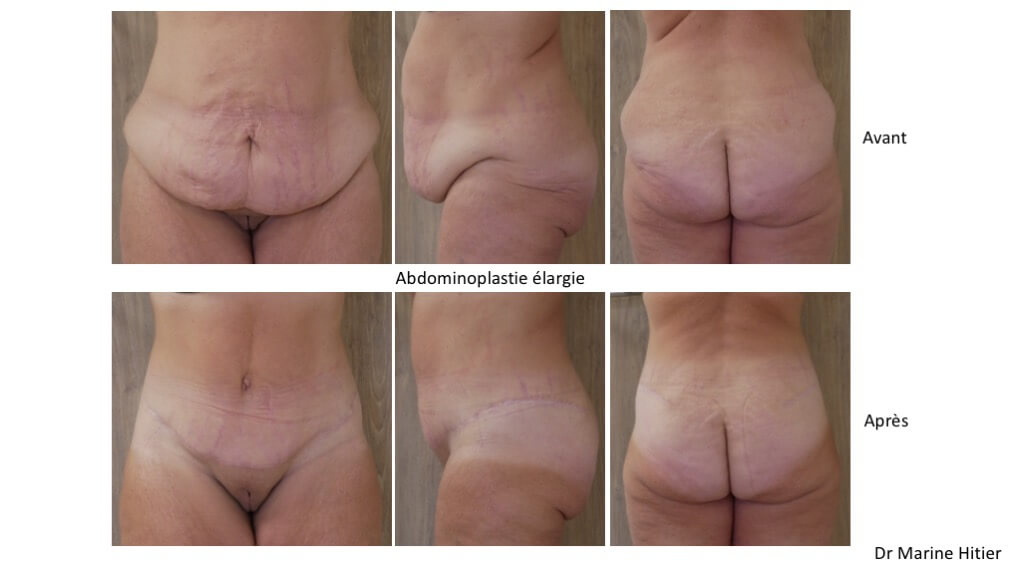 abdominoplastie lipoaspiration