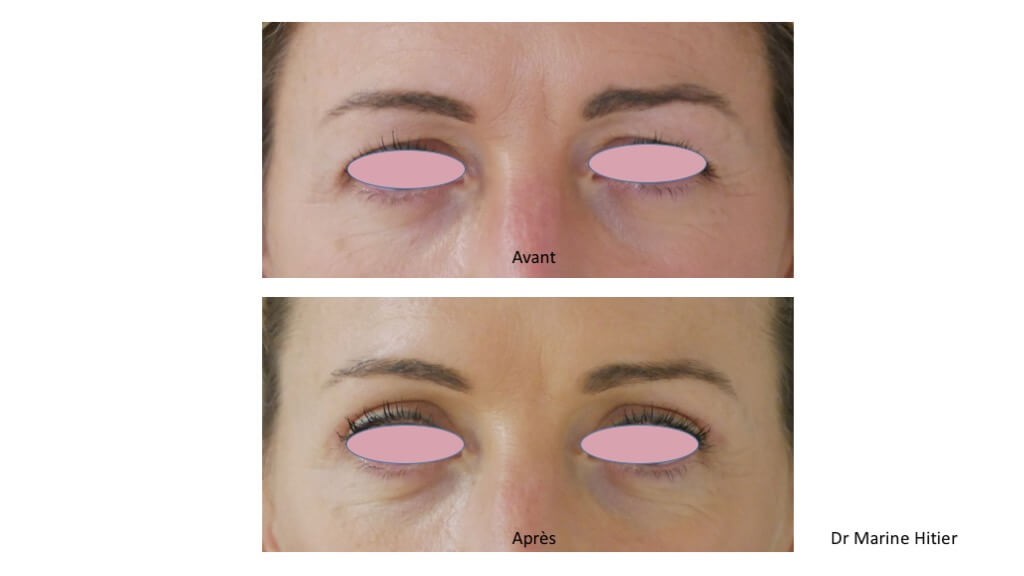 blepharoplastie supérieure chirurgie des paupières