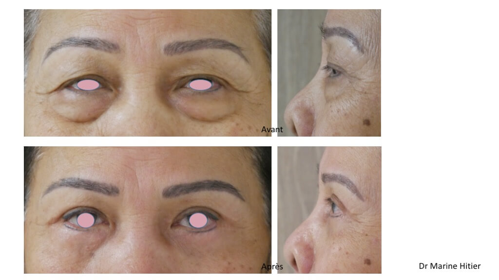 blepharoplastie 4 paupières lipofilling