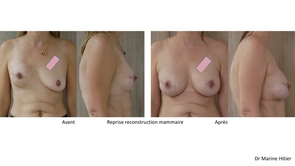 reconstruction mammaire par prothèse après cancer du sein