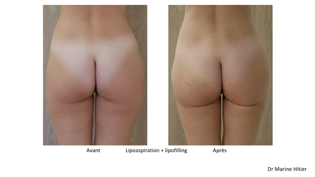 lipoaspiration lipofilling fessier