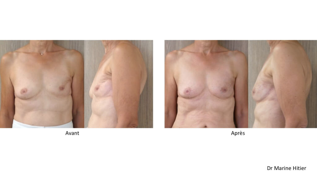 tumorectomie lipofilling reconstruction mammaire