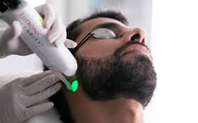 épilation définitive laser barbe homme