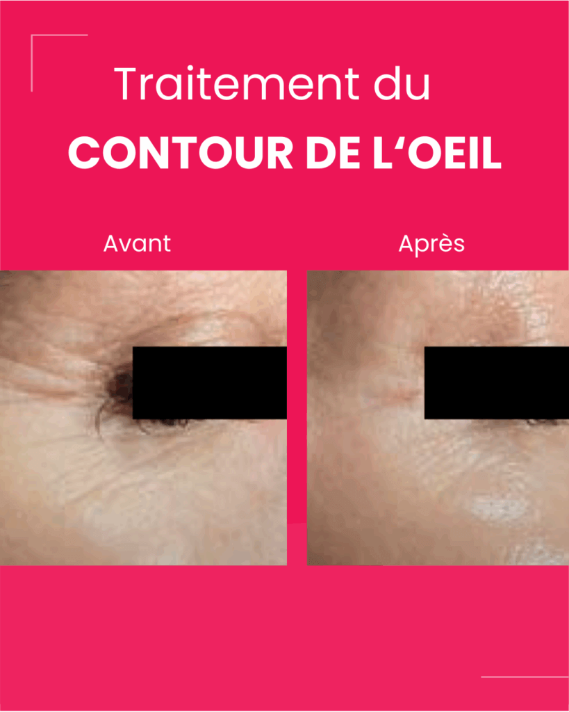 Retix C All Eye Therapy